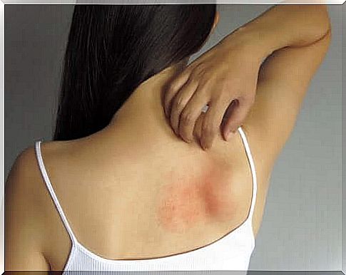 5 topical treatments to relieve rashes