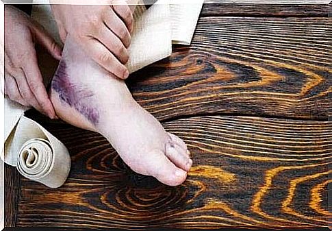 A swollen foot with a large purple bruise.