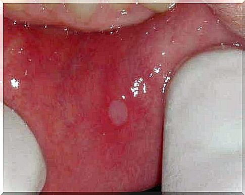 Mouth sores on gums