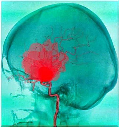 Cerebral hemorrhage and subdural hematoma