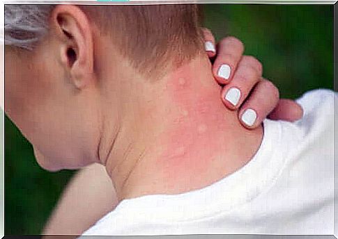 Everything you need to know about mosquito bites