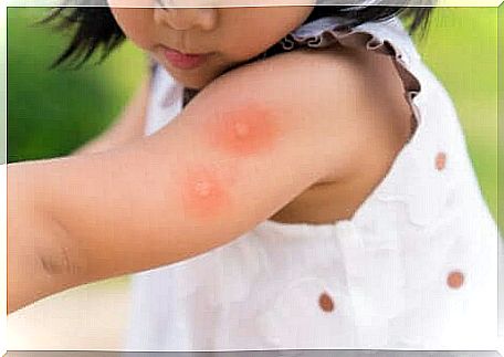 Young girl with mosquito bite on her arm.