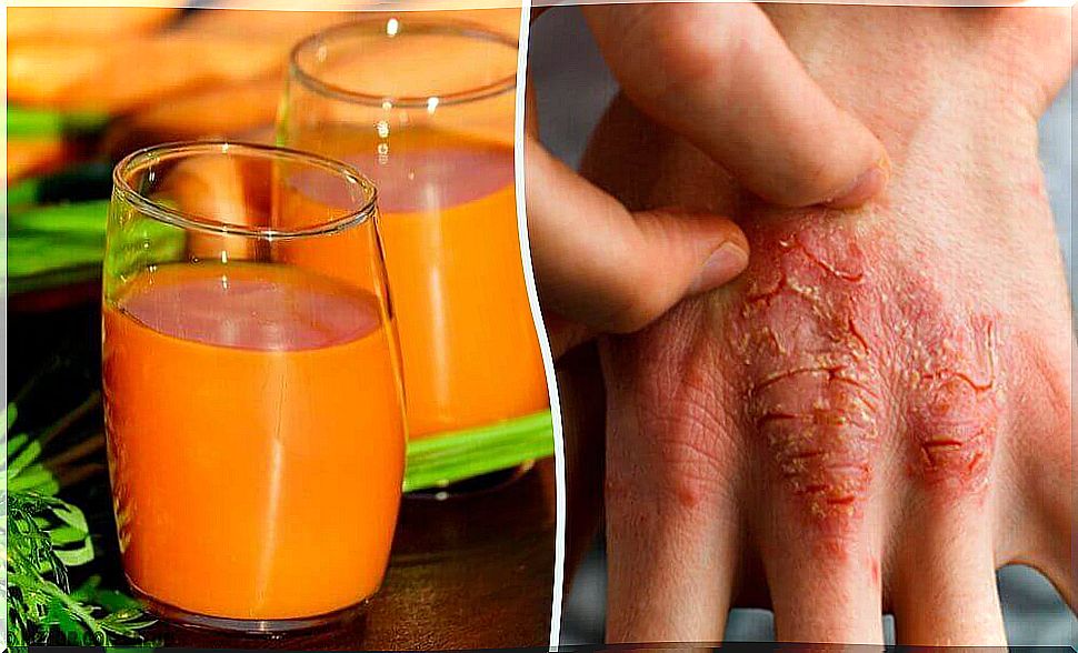 Fight and avoid psoriasis with these 7 natural remedies