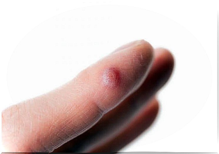 Five solutions to remove warts on your fingers