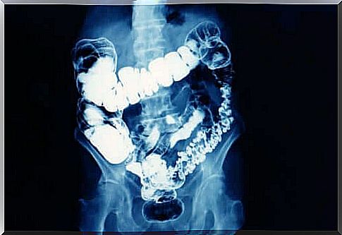 Irritable bowel syndrome - X-ray