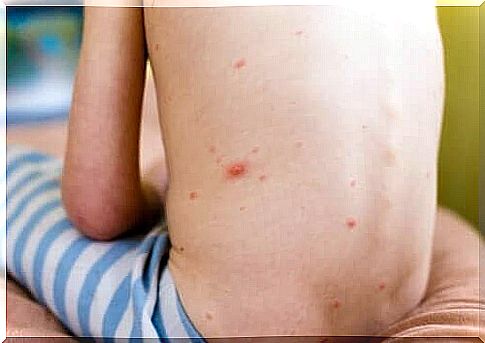 A child with hives on his back