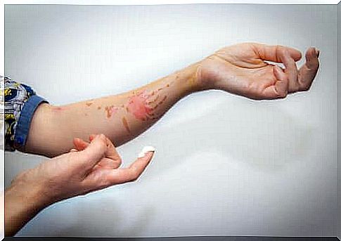 Learn how to treat superficial burns