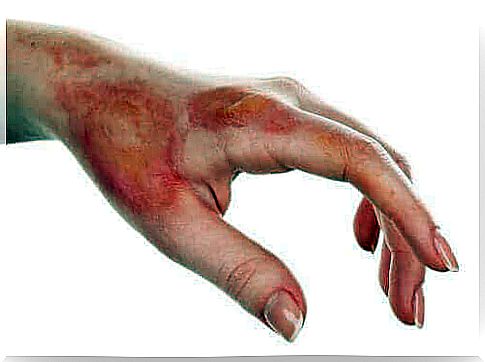 Hand with burns