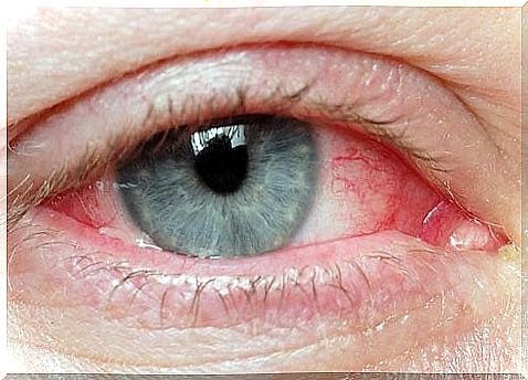 Natural ways to relieve irritated eyes