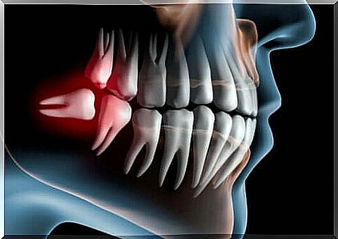 Symptoms of ingrown wisdom teeth and treatment