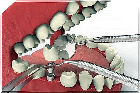 Dental implants to treat tannagenesis