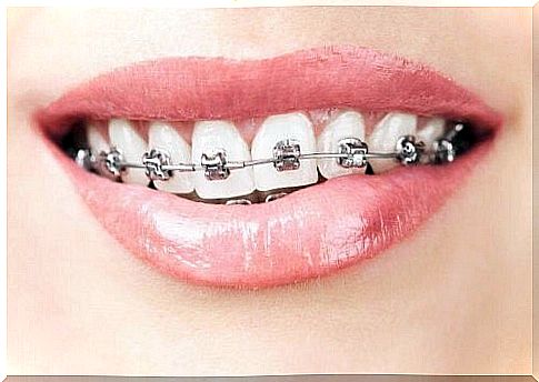 Woman with braces