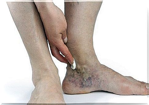 2-swollen ankles